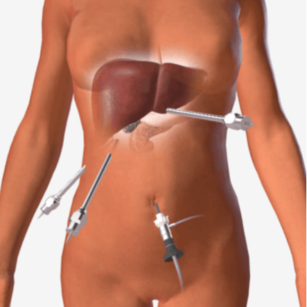 Λαπαροσκοπική χολοκυστεκτομή - Gallbladder Laparoscopy