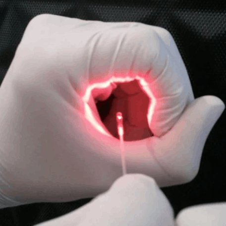 Λέιζερ Αιμορροϊδες, Συρίγγιο, Κόκκυγας - laser hemorrhoids fistula pilonidal